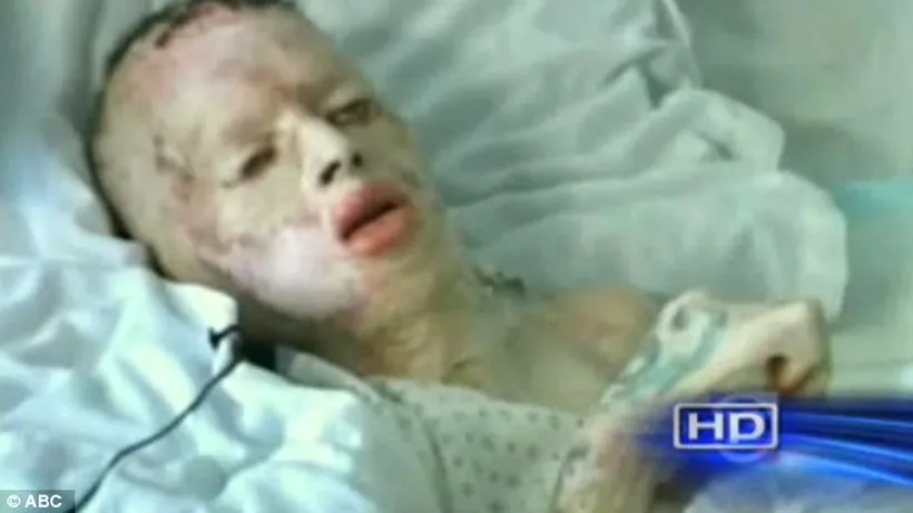 VIDEO. Mărturie cutremurătoare de pe patul de moarte a unui tânăr care în urmă cu 13 ani a fost ars de viu