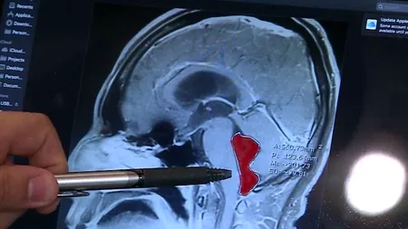 Un bărbat care a suferit dureri de cap ani de zile a descoperit că avea viermi care trăiau în creierul lui