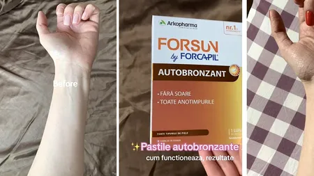 Ce a pățit o tânără din IAȘI, după ce a luat pastile autobronzante. Cum arată pielea ei acum