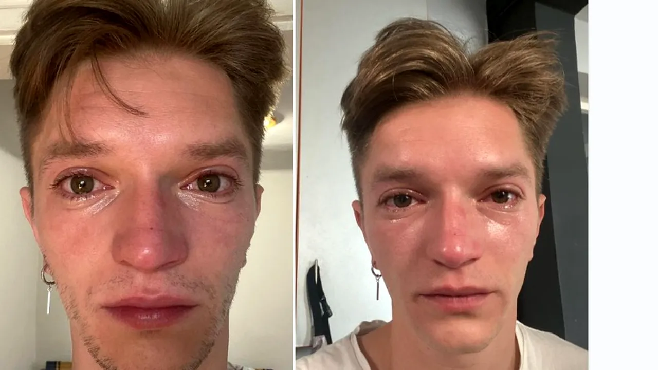 Anchetă la Spitalul Judeţean Sibiu după ce un actor a fost trimis acasă din UPU cu arsură de cornee