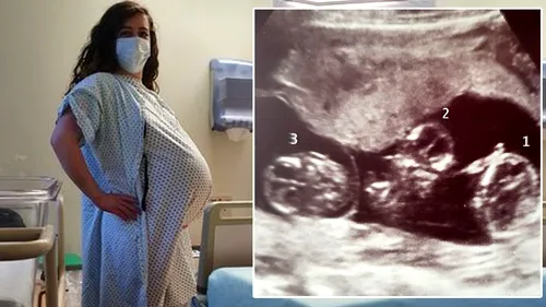 Caz aproape unic în istoria omenirii! Ce a născut graviduța din imagine. Se întâmplă o dată la 200.000.000 de cazuri