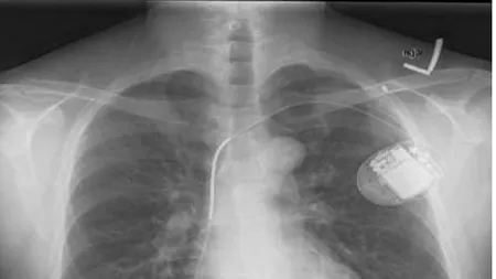 Erori fatale ale implanturilor medicale. Ce au descoperit cercetătorii când au verificat software-ul