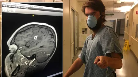 Povestea ireală a bărbatului din imagine. Alarmat de durerile de cap din ce în ce mai frecvente, a fost la control. Medicilor nu le-a venit să creadă - ce au găsit pe creierul lui