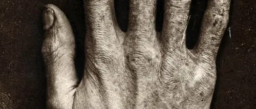 Șocant: Cum arăta mâna omului care a testat tuburi cu raze X pentru celebrul inventator Thomas Edison - FOTO