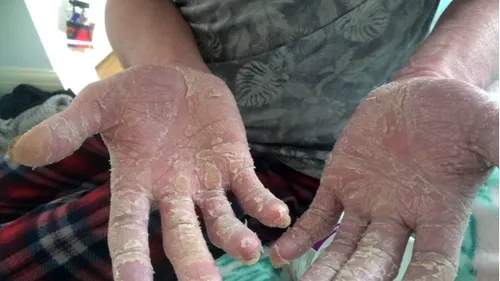STRIGĂT DE AJUTOR. Mărturia unui bolnav: M-am gândit că este o erupție cutanată, dar boala îmi acoperă acum 90% din piele, despicându-mi mâinile și picioarele