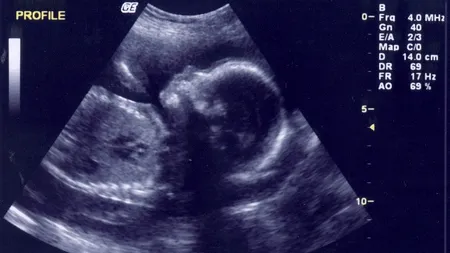 Cum a fost întâmpinat de familie bebelușul născut fără picioare