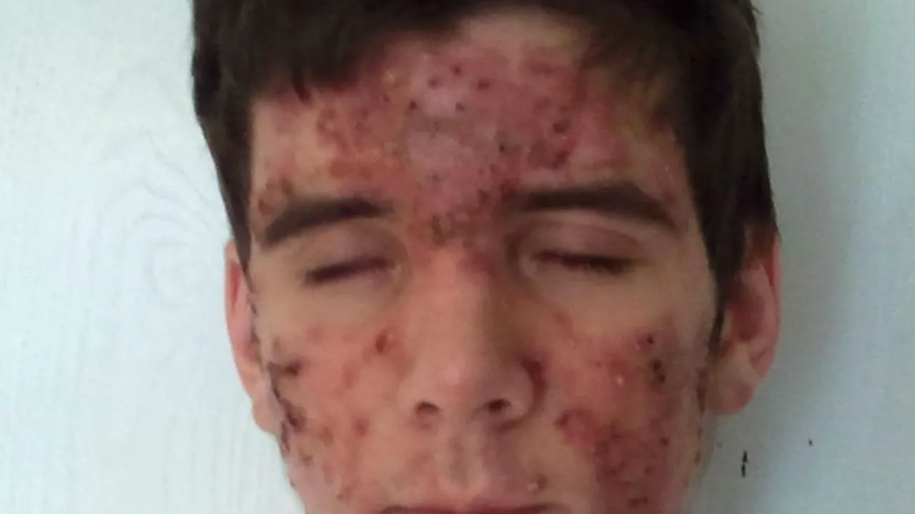 Transformarea unui tânăr desfigurat de acnee