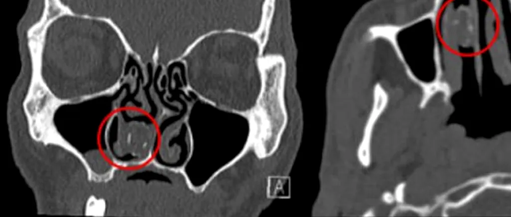 A fost găsit după 18 ani de dureri și infecții. Descoperire neșteptată în nasul unui deținut: „Am crezut că îl înghițisem, dar...