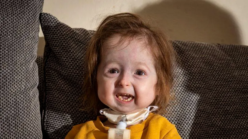 Fetiță de doi ani, singurul pacient din lume care suferă de boala prezentată în filmul „Benjamin Button. Maladia i-a provocat o îmbătrânire prematură a organismului 