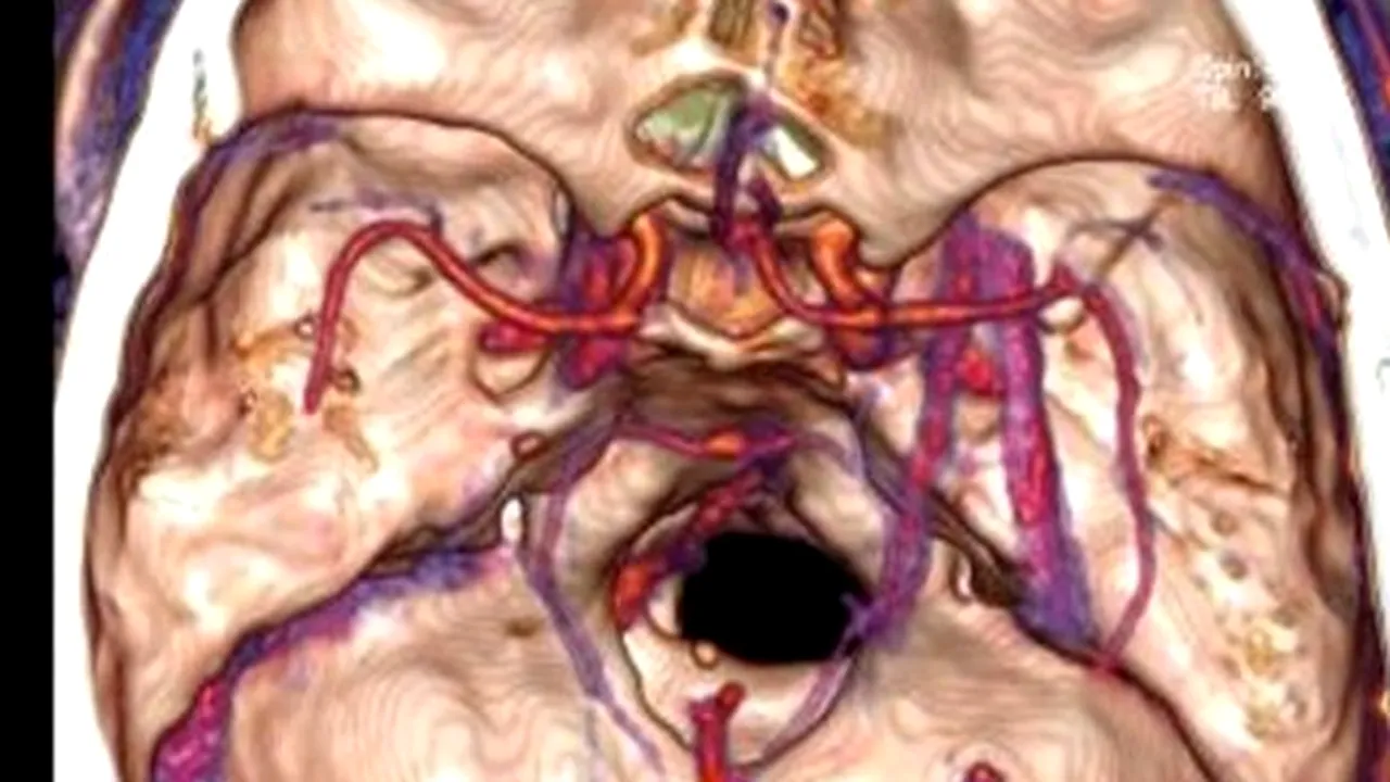 Avea dureri de cap frecvente, dar habar nu avea cu ce trăise în creier atâția ani - FOTO 