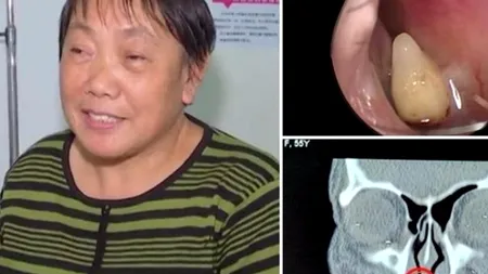 O femeie a avut simptome de răceală timp de mai multe decenii. Când a ajuns la spital, medicii au făcut o descoperire bizară