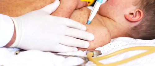 Rujeola, o amenințare globală iminentă din cauza pandemiei. Aproape 40 de milioane de copii nu au fost vaccinați împotriva bolii anul trecut / Avertismentul OMS