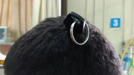 Cazul incredibil al omului care a avut o cheie înfiptă în creier. Cum a supraviețuit bărbatul