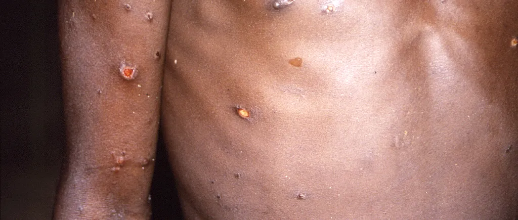 A fost confirmat primul caz de variola maimuței în România. Virusul, depistat la un bărbat din București