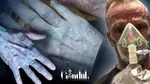 Un bărbat de 42 de ani a ajuns la spital după ce i s-a albăstrit pielea: „Arătam ca personajele din filmul Avatar”