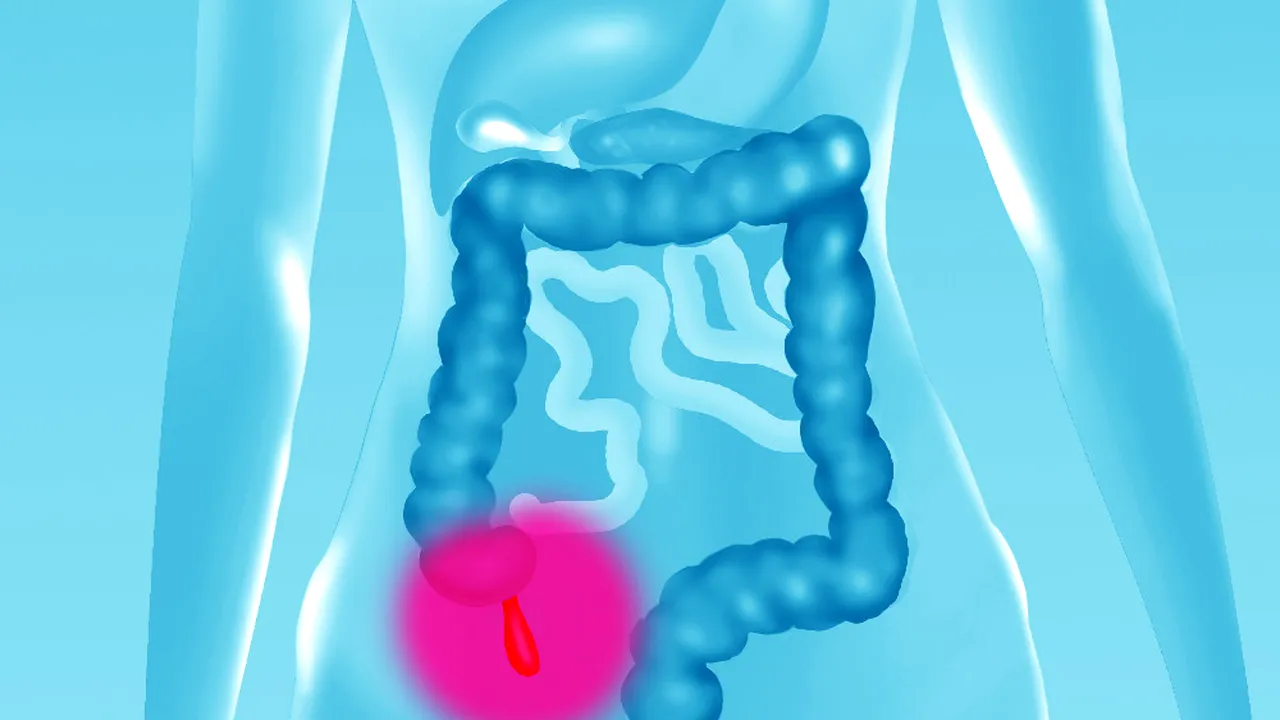 Apendicita - cauze, simptome, tratament