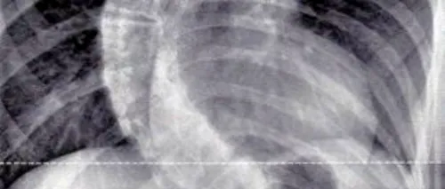 Medicii britanici au fost uimiți când au văzut radiografia unei fete de 13 ani: „Este cel mai grav caz pe care l-am întâlnit