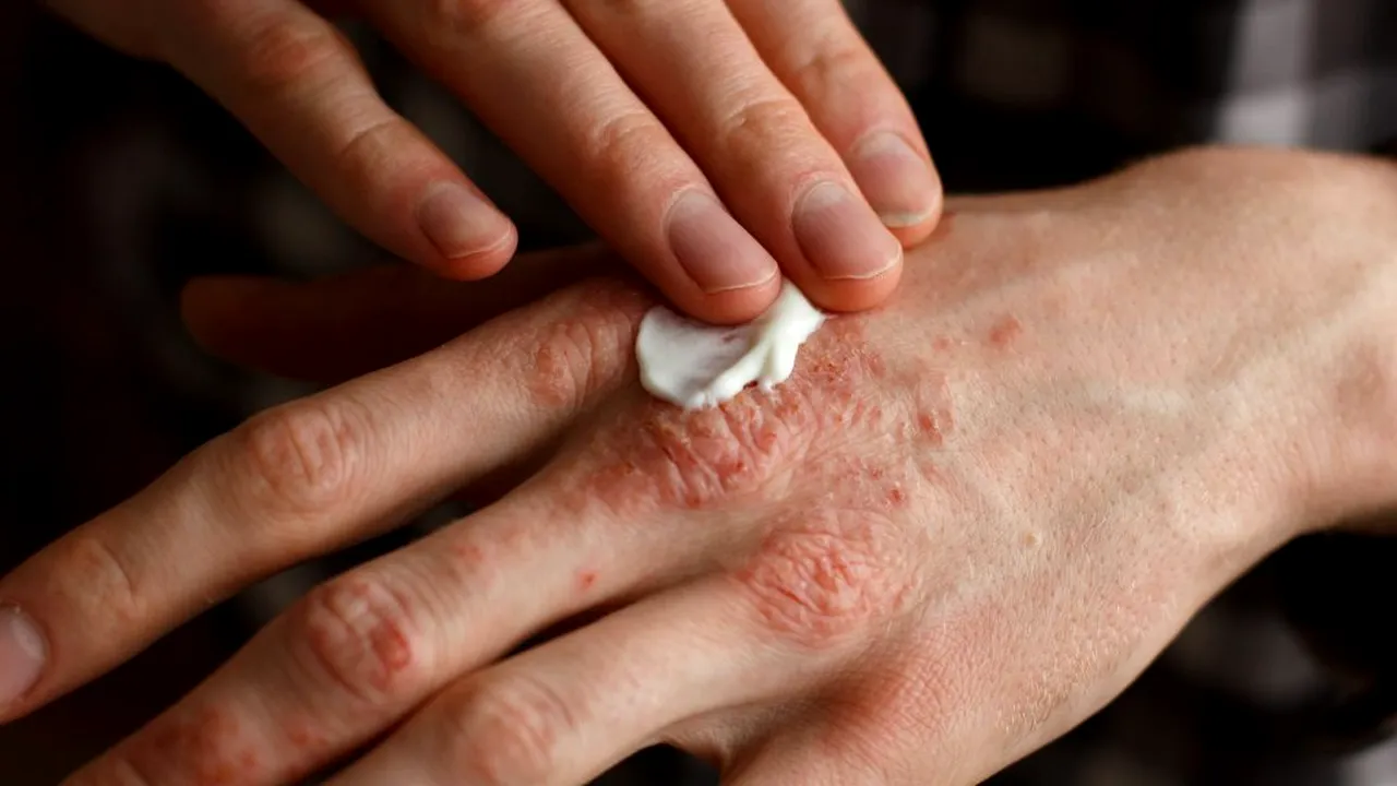 Boala declanșată de stres și care nu se vindecă! Mulți tineri se confruntă cu ea și au probleme de socializare