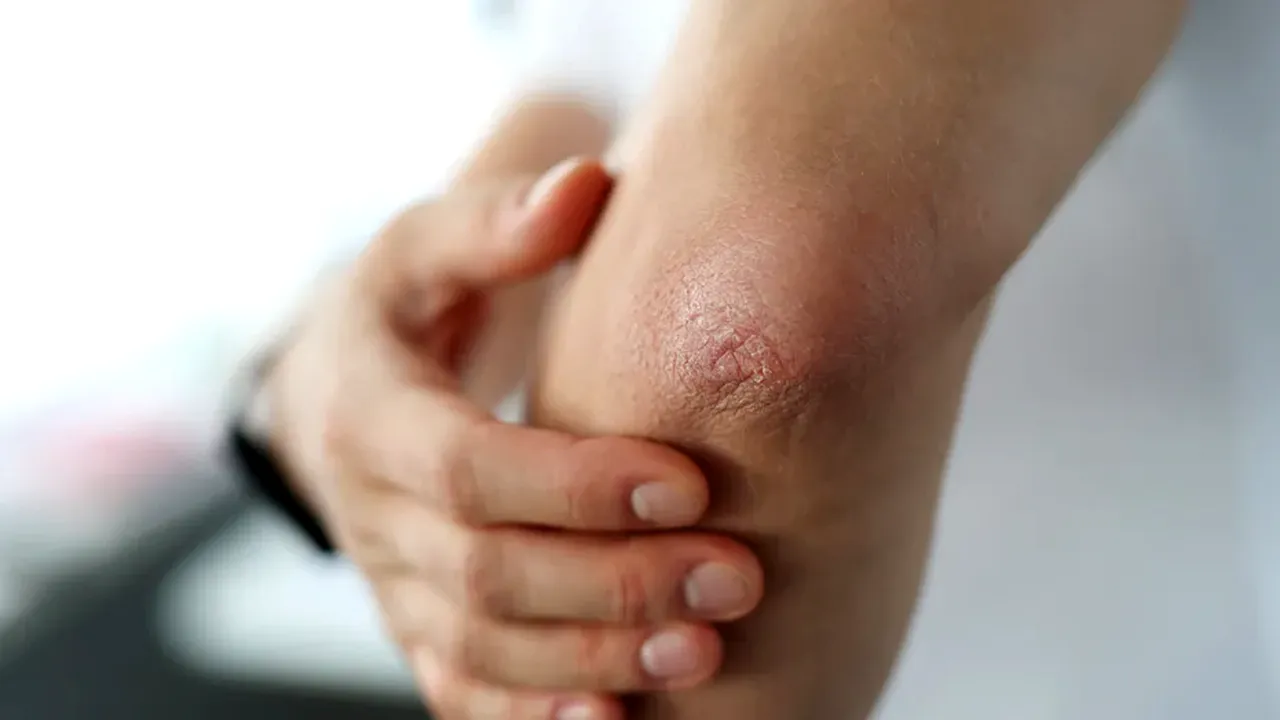 Semnul unei inimi bolnave care apare ÎN COT. Cum poți preveni infarctul sau accidentul vascular cerebral