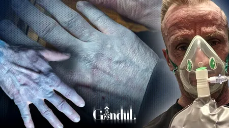 Un bărbat de 42 de ani a ajuns la spital după ce i s-a albăstrit pielea: „Arătam ca personajele din filmul Avatar”. Ce s-a întâmplat de fapt