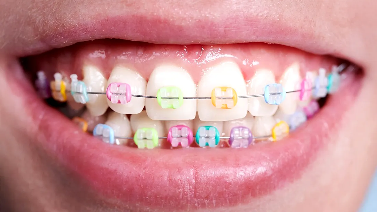 (P) Aparat dentar ceramic – confort și rezultate estetice