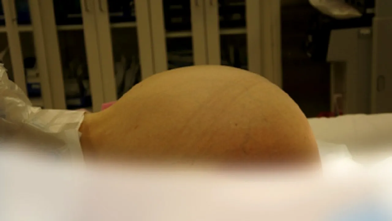 O tumoare de 23 kg, extirpată din abdomenul unei femei din Bulgaria