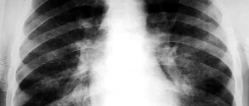 Neoplasm pulmonar, boala anului 2023. Avertismentul medicilor: nu doare, dar este fatală! Semnele care trebuie să te îngrijoreze