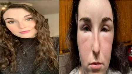 O femeie a ajuns în spital, după ce vopseaua de păr i-a provocat reacții alergice severe. Acum este de nerecunoscut