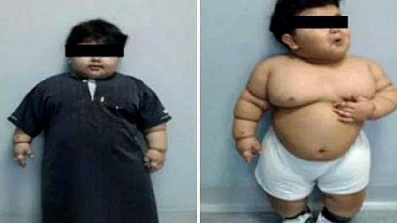 Un copil de doi ani este cea mai tânără persoană supusă unei intervenții de micșorare a stomacului. Cât a ajuns să cântărească