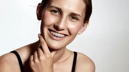 (P) 4 tratamente dentare pe care le poți face în timp ce porți aparat ortodontic