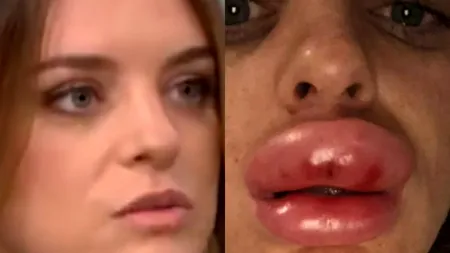 Medicii au râs de aspectul ei. Coșmarul tinerei care s-a temut că își va pierde buza de sus. „Nu vă lăsați injectate de persoane neavizate!