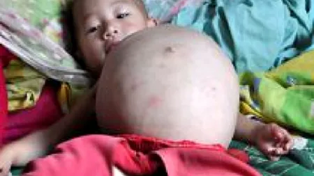 VIDEO. Ce au descoperit medicii în stomacul unui băiețel în vârstă de doi ani