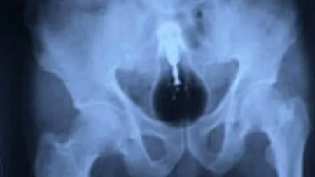 Cele mai ciudate lucruri pe care doctorii le-au găsit în stomacul pacienților. GALERIE FOTO