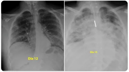 Cum macină organismul virusul SARS-CoV-2. În trei zile, coronavirusul îți „mănâncă” ambii plămâni!