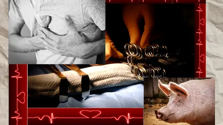 Ce a pățit al doilea om din lume care a primit o inimă de PORC. Corpul său a reacționat violent după operație