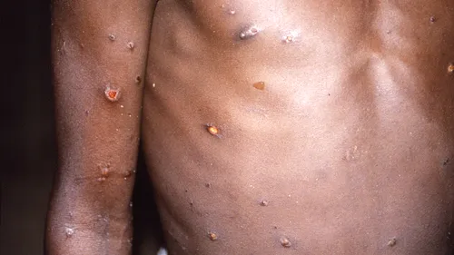 A fost diagnosticat al patrulea caz de variola maimuței în România. Pacientul este contact direct cu primul infectat