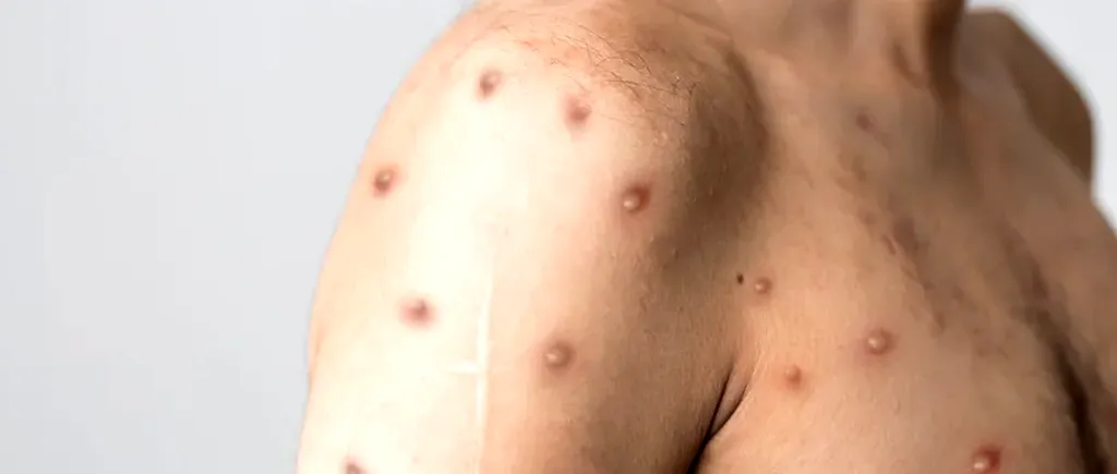 Cazurile de variola maimuței au crescut de trei ori în ultimele două săptămâni, în Europa. Autoritățile cer acțiuni urgente