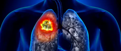 Românii care vor să afle dacă au simptomele cancerului pulmonar pot face un test online