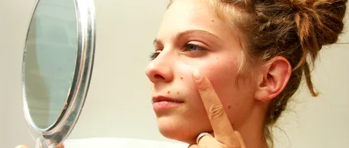 Șase mituri frecvente despre acnee: De la pasta de dinți la statul la soare