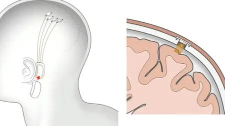 Synchron, compania finanțată de Jeff Bezos și Bill Gates, începe testele cu implanturi în CREIER. Sunt rivalii Neuralink, start-up-ul lui Elon Musk