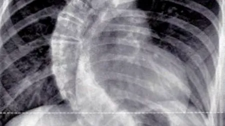 Medicii britanici au fost uimiți când au văzut radiografia unei fete de 13 ani: „Este cel mai grav caz pe care l-am întâlnit