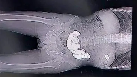 Caz unic în istoria omenirii! Ce au găsit medicii în stomacul unui bărbat care se internase pentru că se simțea 