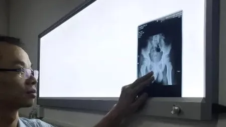 Măsură extremă: Un băiat și-a introdus un ac în penis. Motivul: Trebuia să stau treaz să-mi fac temele - GALERIE FOTO