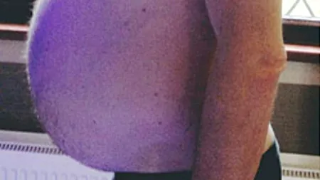 A crezut că s-a îngrășat de la bere, dar medicii i-au dat vestea care i-a schimbat viața