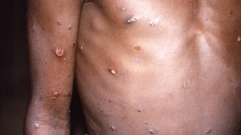 Un nou caz de variola maimuței, diagnosticat în România. Este a treia persoană la care se descoperă boala în țara noastră
