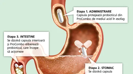 (P) Stomacul îi chinuie pe români