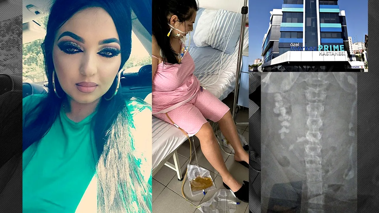 EXCLUSIV | O româncă era să moară după ce a făcut operație de micșorare a stomacului în Turcia. „Mi-au dat morfină și mi-au spus că sunt sănătoasă”