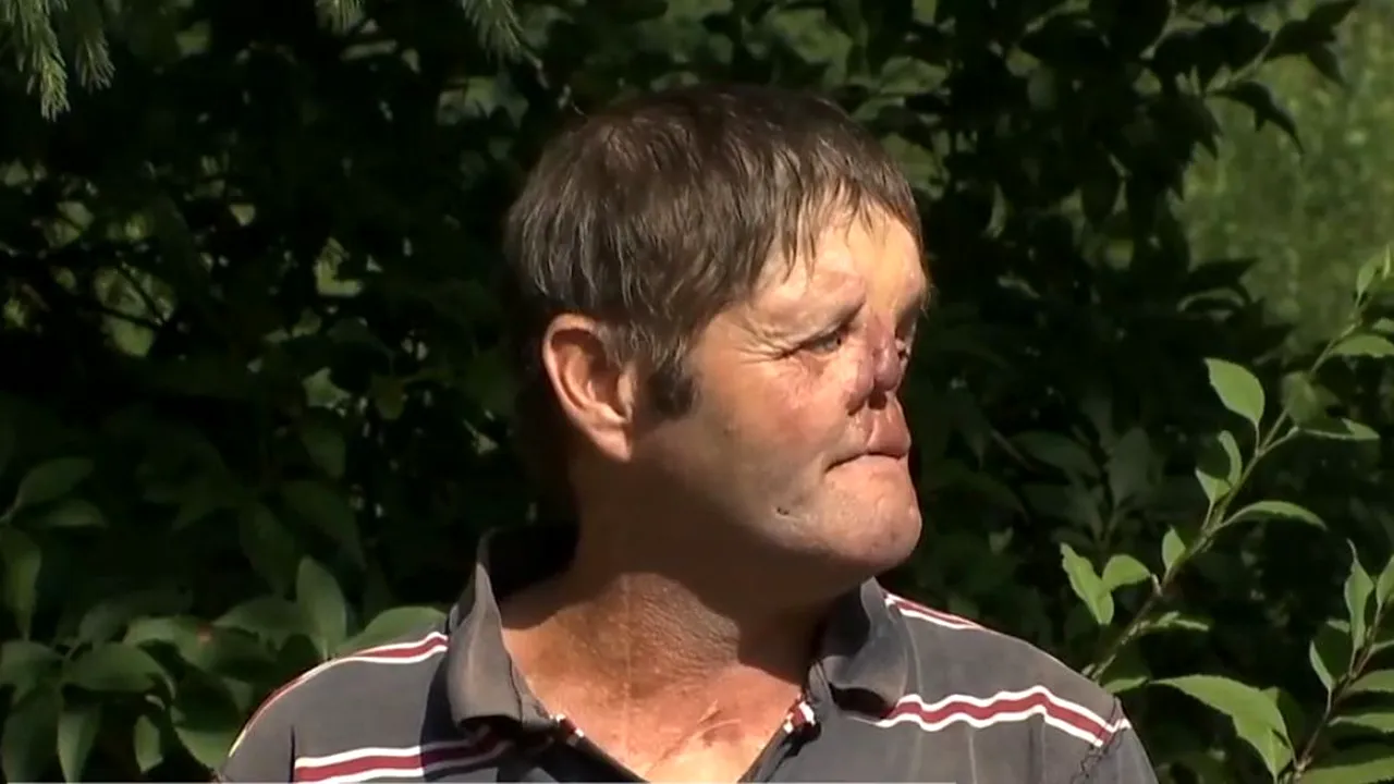 Mărturia cutremurătoare a bărbatului desfigurat de urs și operat de 80 de ori: „Mi-a mușcat fața”