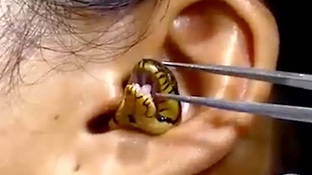 VIDEO | Imagini bizare: Un „chirurg” scoate un șarpe viu din urechea unei femei / Filmarea a ajuns virală