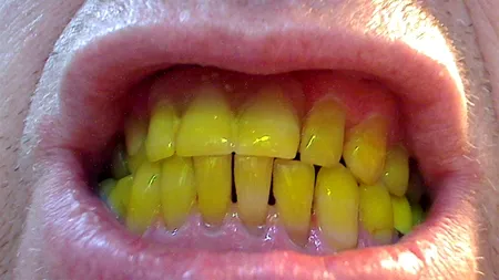 Cele 5 alimente care îți DISTRUG dantura mai rău decât țigările, potrivit experților